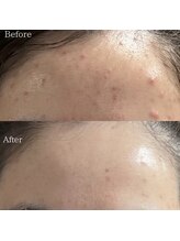 サロンドシェフィア(Salon de Chefia)/20代後半女性 症例写真