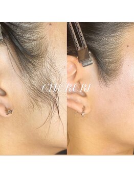 チュルリ 新町店(Chururi)/もみあげ脱毛