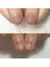 セラキュアネイル(Theracure nail)/噛む癖でお悩みの爪