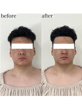 ヴェルシック(Belchic)/痛みが少なく効果が高いのが特徴