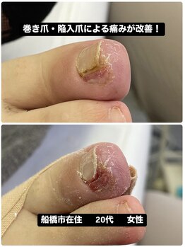 巻き爪じゅん 船橋店/巻き爪・陥入爪による痛みが改善