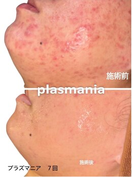 アールスタイルビューティ(R STYLE BEAUTY)/プラズマハ-ブピ-リング赤ニキビ