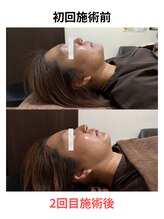 ケンビ(Kenbi)/美容鍼×レモンボトル《吉野町》