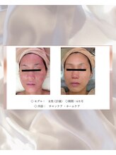 エテル(eter)/エクスビアン　PHA水光ピール