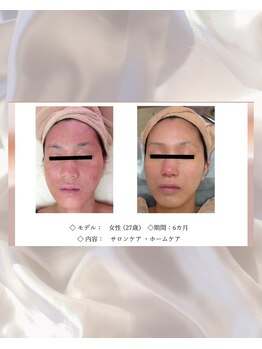 エテル(eter)/エクスビアン　PHA水光ピール