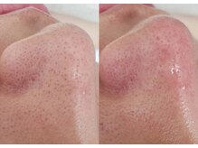 プシュケ(Psyche)/黒ずみ撃退!毛穴の大掃除