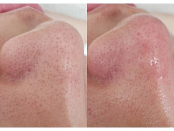 プシュケ(Psyche)/黒ずみ撃退!毛穴の大掃除