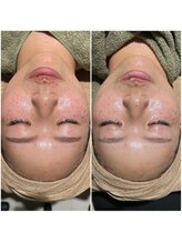 シンスプラス(SINCE+)/1回の変化（アンストレス）乳酸