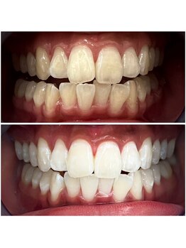 モイス(Moisu)/驚愕の白さ★ホワイトニング