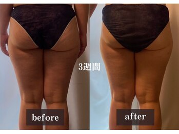 ダンデライオン 天神南店(dandelion)/痩身エステたったの1ヶ月