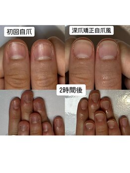 ティアラネイル 宇都宮/深爪矯正