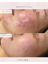 ディシエル(D'ciel)/美肌育成/ニキビ改善
