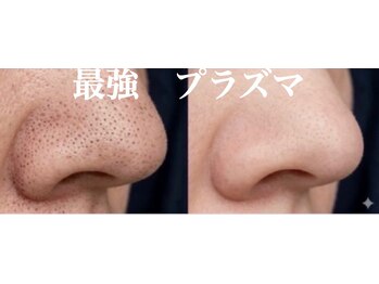 美的アヴェニール(美的.Avenir)の写真/毛穴の開き・引き締め・トーンアップ☆
気になる箇所、徹底ケア！！