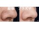 美的アヴェニール(美的.Avenir)の写真/毛穴の開き・引き締め・トーンアップ☆
気になる箇所、徹底ケア！！