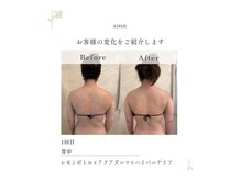 ADIMU　privatebeautysalonの雰囲気（【背中】ハイパーナイフ×レモンボトル痩身◎）