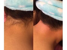 ベル(Belle)/うなじワックス脱毛