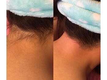 ベル(Belle)/うなじワックス脱毛