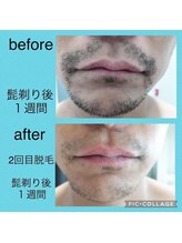 ウルル(Ululu)/【メンズ脱毛】髭脱毛2回目　