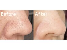 ファン 骨整体 アンド ビューティー ファン 鍼灸(Fan 骨整体&Beauty Fan 鍼灸)/徹底毛穴洗浄