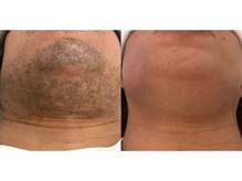 ワイスタイル(Ystyle)/40代男性　ヒゲ脱毛５回