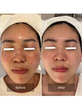 マインエム(mine.m)/長年のニキビ・毛穴・シミ