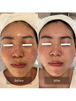 マインエム(mine.m)/長年のニキビ・毛穴・シミ