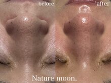 ナチュールムーン(Nature moon.)/毛穴洗浄