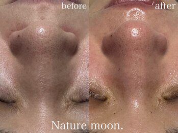 ナチュールムーン(Nature moon.)/毛穴洗浄