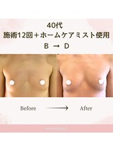 ミミバスト(mimibust)/バストアップBeforeAfter