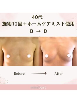 ミミバスト(mimibust)/バストアップBeforeAfter