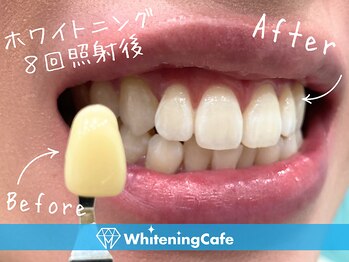 ホワイトニングカフェ 千葉店/ホワイトニング8回照射後*男性