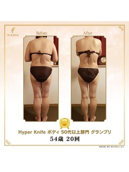 リンカ(Rinka.)/☆帯広初!!ハイパーナイフ導入☆