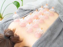 鍼グリッター 岡山本院(鍼Glitter.)の雰囲気（施術後のすっきり感がやみつきになるカッピングは蓄積疲労に◎）
