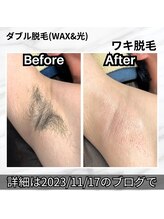 エスポワール(Espoir)/ワキ脱毛　快適×臭い防止！