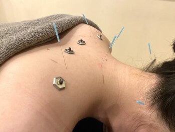 グランツ 京都伏見(Glanz)/首肩鍼灸♪