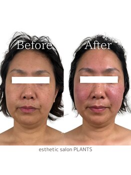 プランツ(PLANTS)/40代／１回／たるみ小顔・首凝り