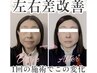【左右差・歪み解消】別人級変化を骨格美成で速攻実現★小顔矯正30分￥4900