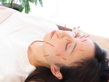 晴(ハレ)の写真/\電気を流す美容鍼★/筋肉を刺激しハリのある肌へ◎フェイスライン引き締め、左右差・たるみ・しわ改善!