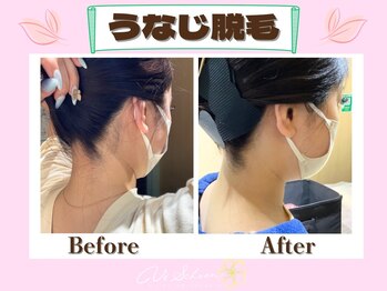 ヴィ シェーン(Vi Schoen)/うなじBefore/After 【W型】