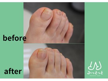 ふっとっと/爪ケア before after