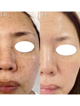 ラボーテエサンテ バイ ティアラ(la beaute et sante by Tiara)/Litでエイジングケア