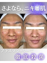 ウニカ(Unica)/プラズマ毛穴＋ニキビ改善２回目