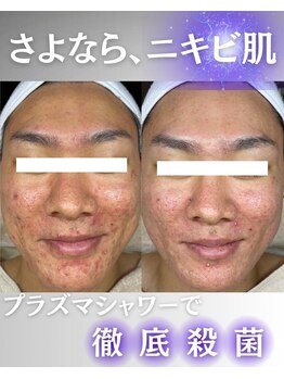 ウニカ(Unica)/プラズマ毛穴+ニキビ改善2回目