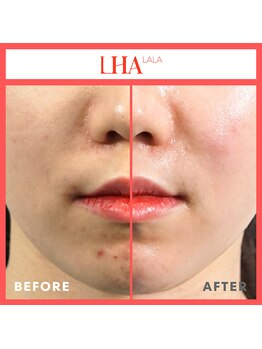 メテ(mete)の写真/毛穴・くすみ改善｜剥かないピーリング『ララピール』でツヤ肌へ導く