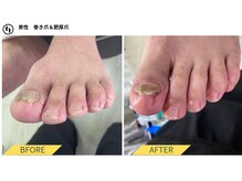 ふっとけ庵/肥厚爪＆巻き爪ケア
