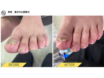 肥厚爪&巻き爪ケア