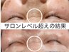 ☆初回人気No2☆定価22000→17000☆最先端韓国肌育ピーリング×韓国LED