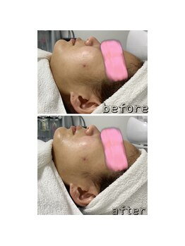 エクスクラメーションマーク(!!!)/ほうれい線が気になる方へ^^