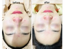 KMB 恵比寿店/毛穴洗浄＋光＋炭酸ガスパック