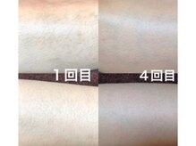 リッカロッカ(RIKKA&ROCCA)/数回でここまで変わる